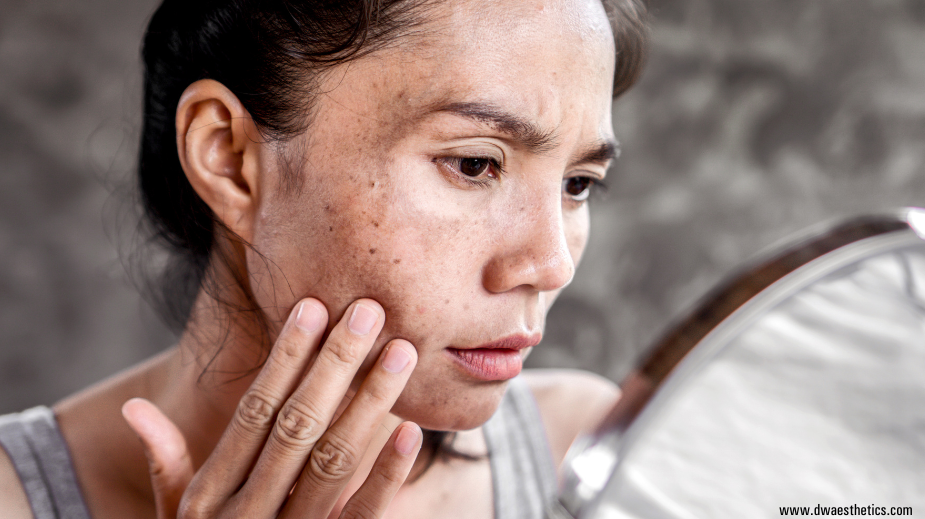 Understanding Melasma: Causes, Treatments, and Finding what Works