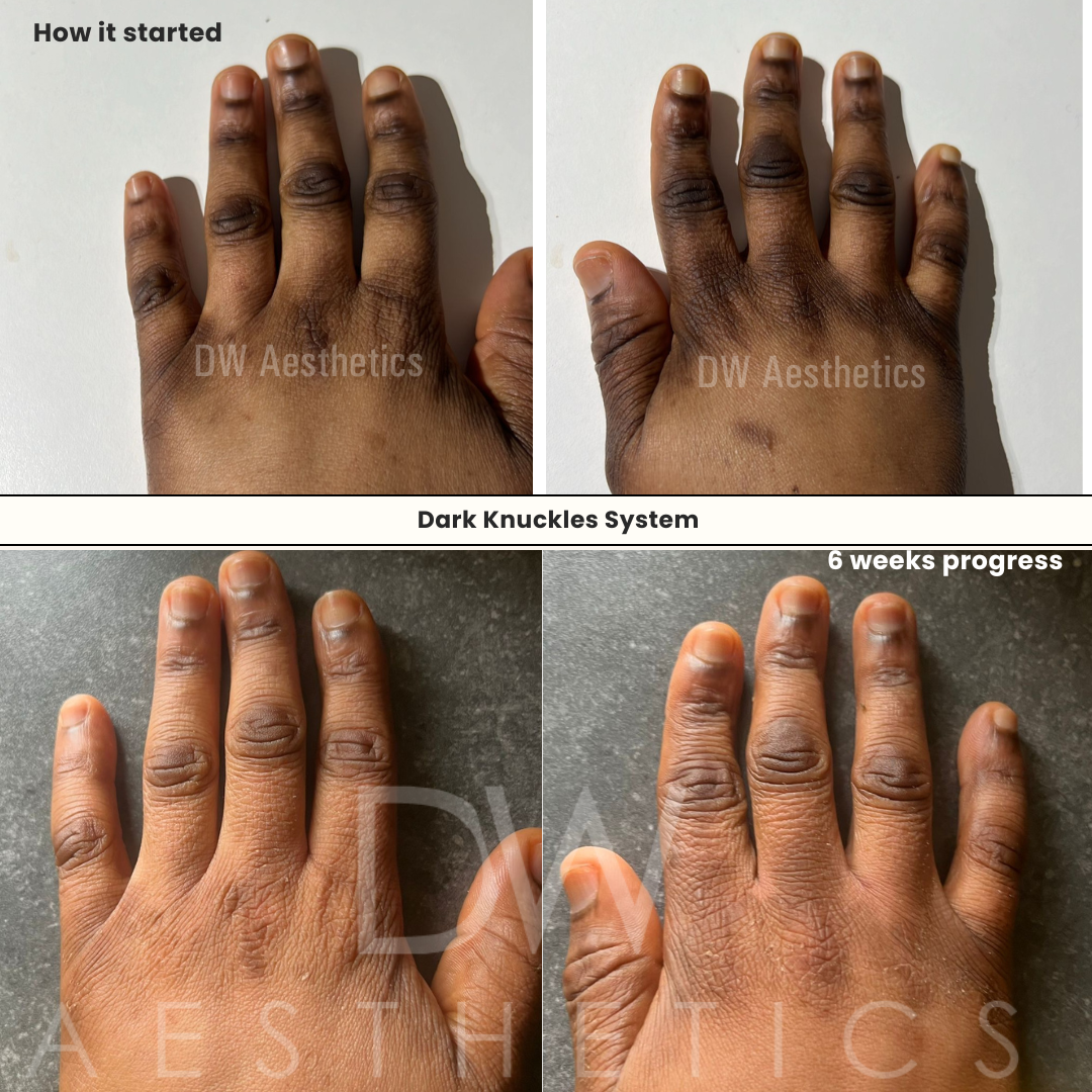 DARK KNUCKLES REMOVER - DW Aesthetics