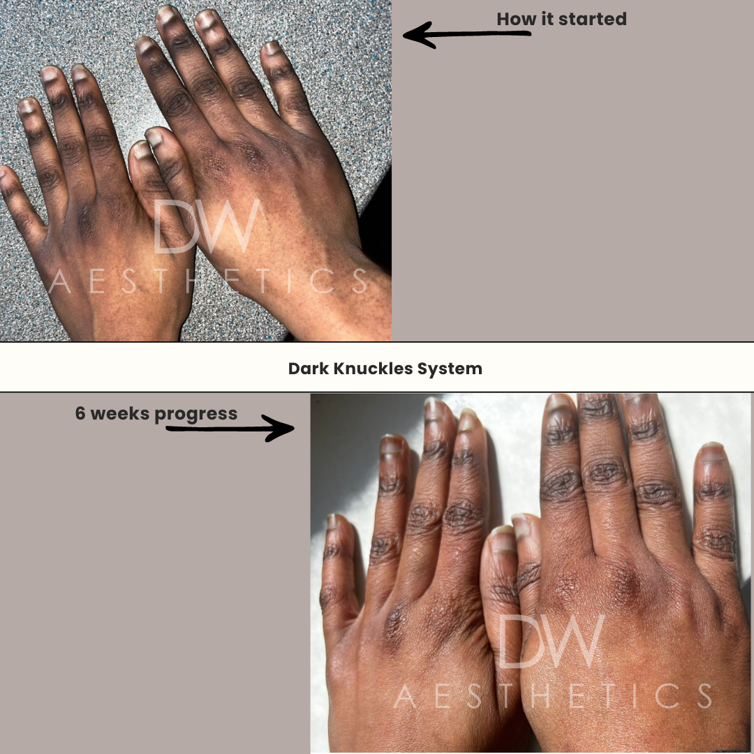 DARK KNUCKLES REMOVER - DW Aesthetics